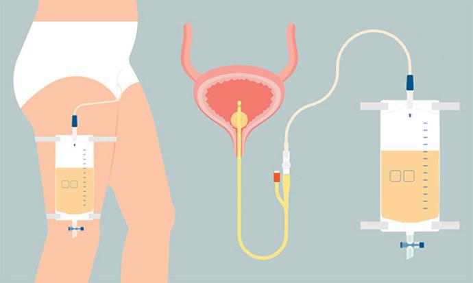 Catheter-associated UTI
